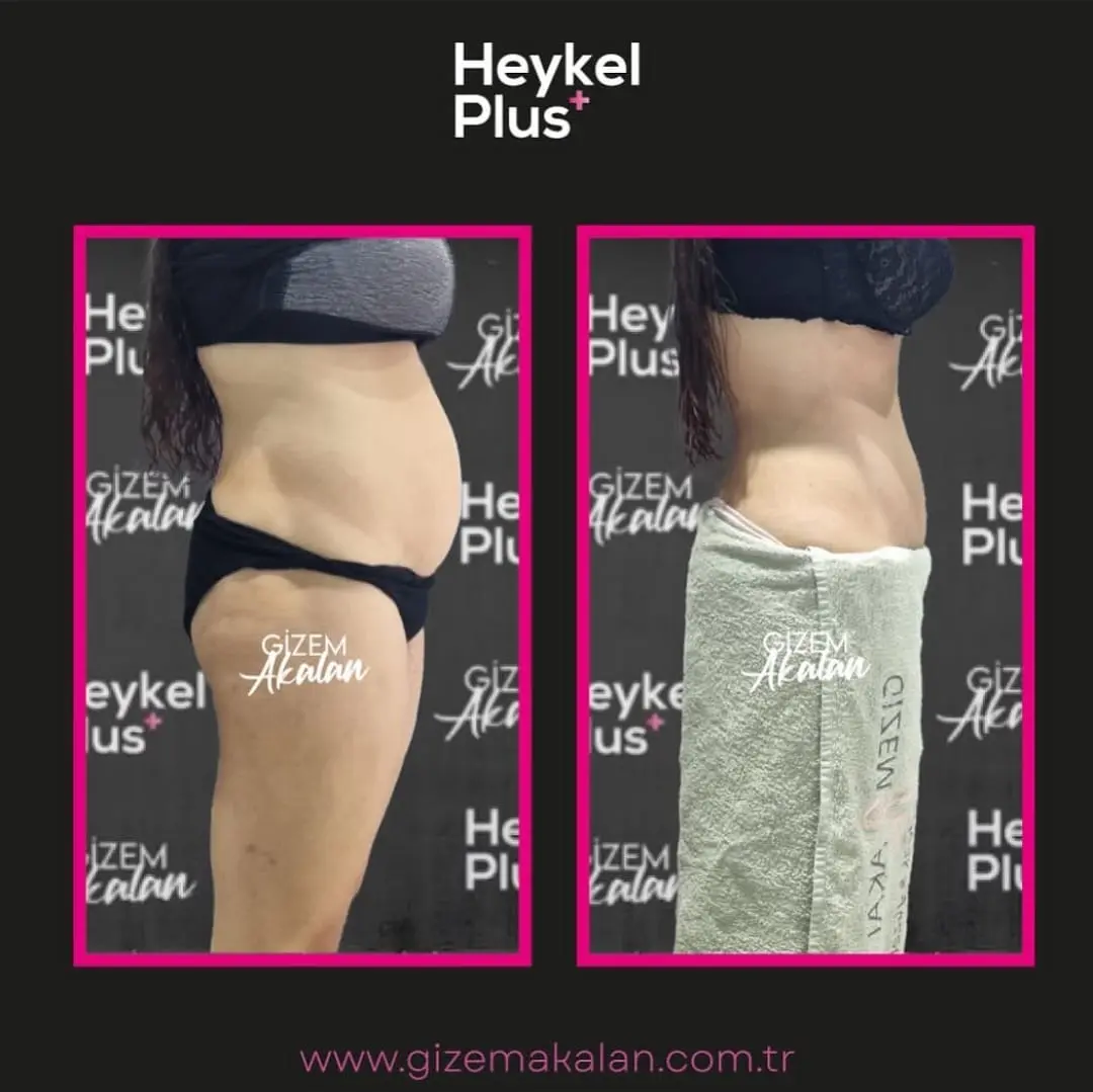 Heykelplus Bölgesel Zayıflama İzmir