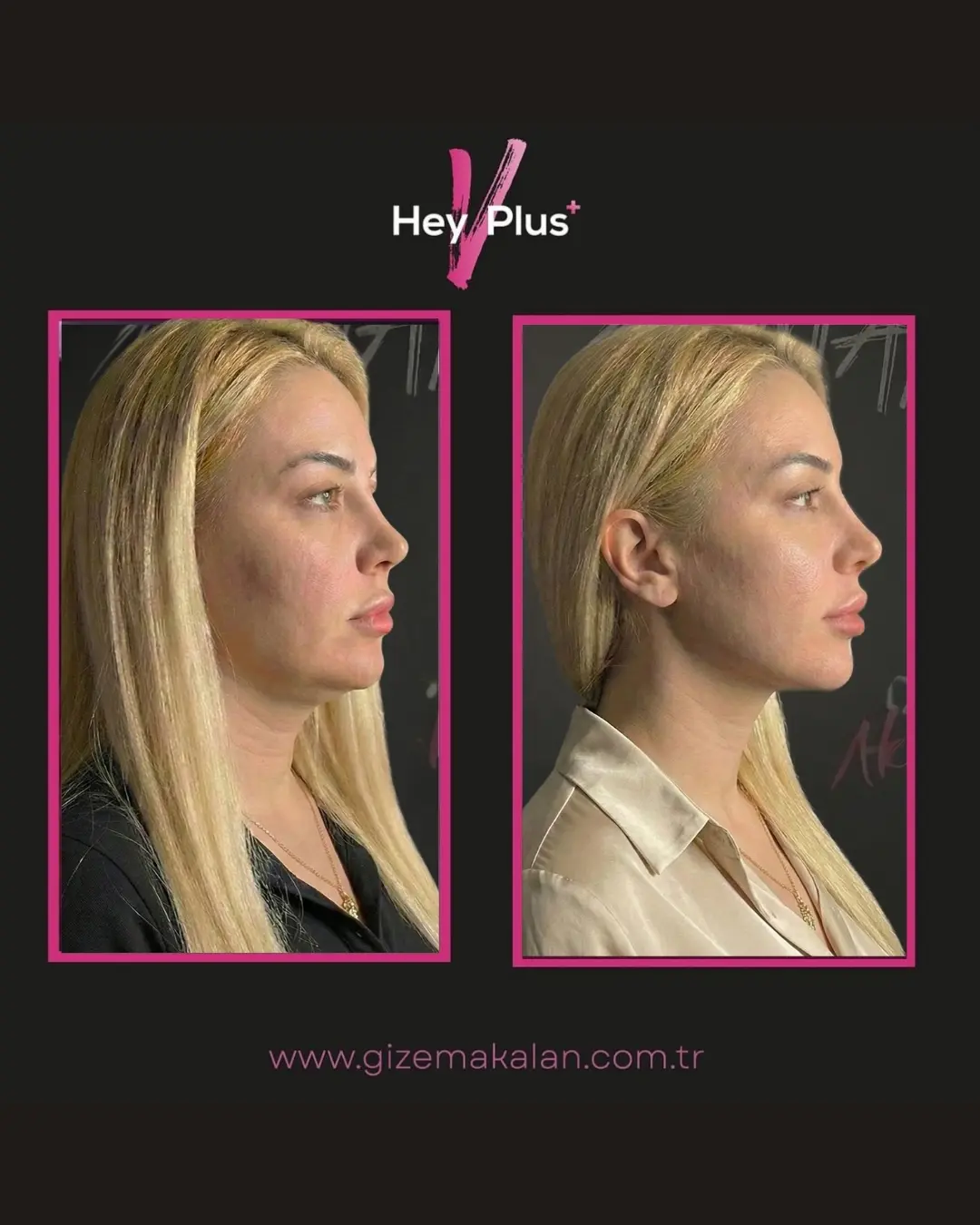 Gizem Akalan Estetik İzmir merkezinde uygulanan HeyVplus+ ameliyatsız yüz germe ve gıdı inceltme işlemi öncesi ve sonrası sonucu.