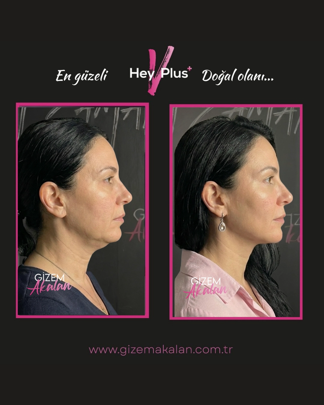 Gizem Akalan Estetik İzmir merkezinde uygulanan HeyVplus+ ameliyatsız yüz germe ve gıdı inceltme işlemi öncesi ve sonrası sonucu.